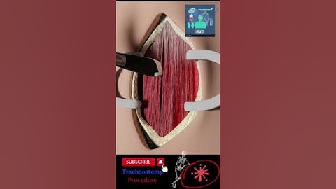 🙏Tracheostomy procedure 3D animation 🙏