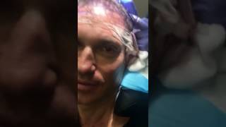 David P Rapaport, MDs hair restoration journey! Part 6