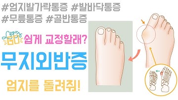 무지외반증 초간단 교정법!(FIX YOUR HALLUX VALGUS)