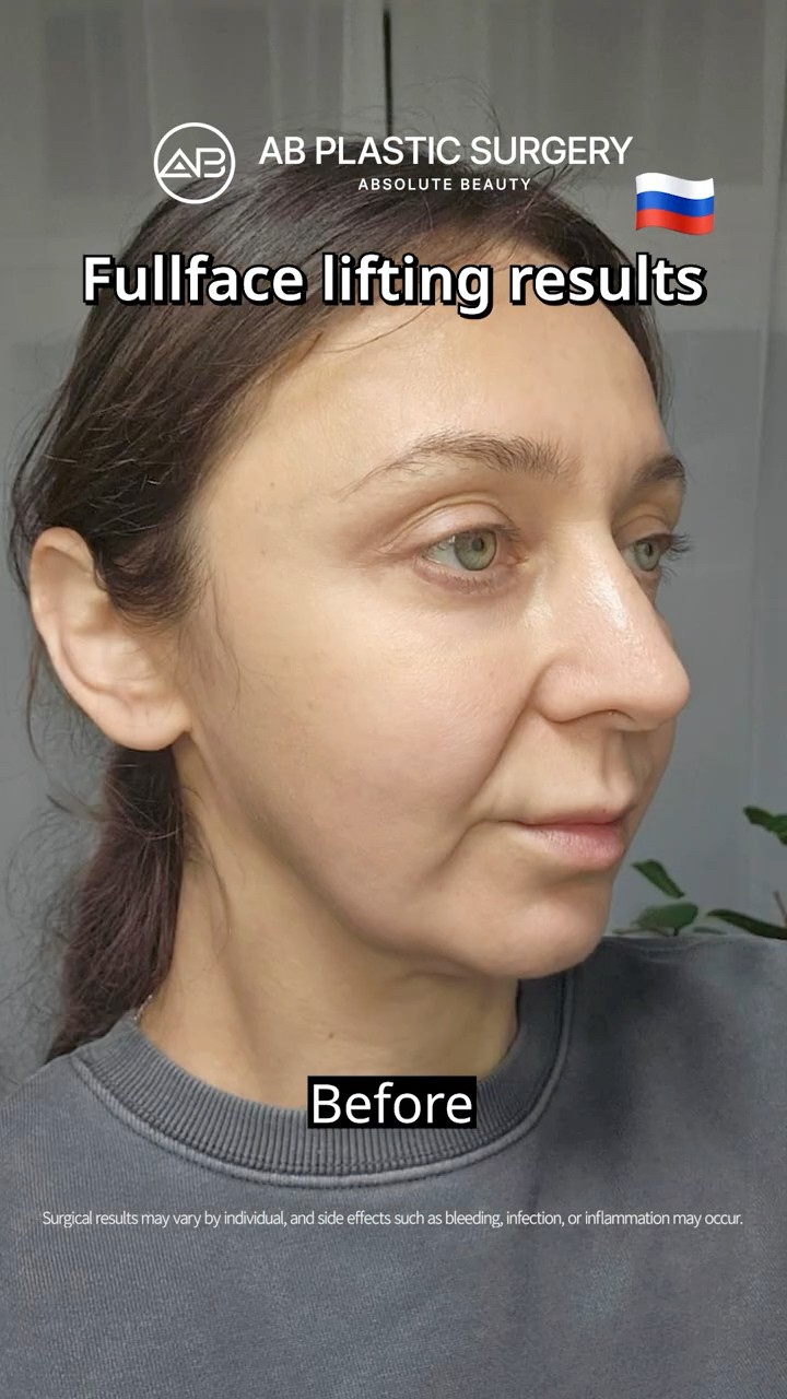Natural Looking Facelift: Flawless from Every Angle Now #shorts