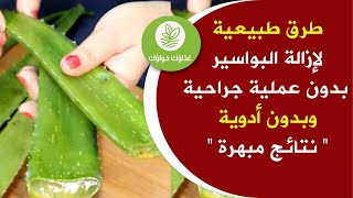 طرق إزالة البواسير بدون عملية جراحية وبطرق طبيعية علاج البواسير الداخلية والخارجة  الأسباب والحلول