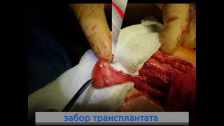 Видео Лечение асептического некроза ладьевидной кости (автор: Виктор Сергеевич Мельников)