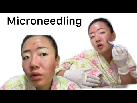 Microneedling equipment’s link given below