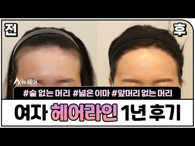 헤어라인교정 1년 후기ㅣ1400모낭 ~ 1800모낭ㅣ뉴헤어