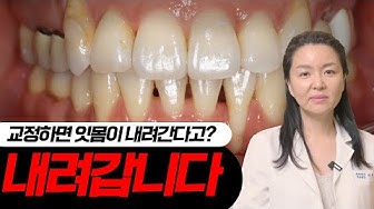 치아교정부작용 - Youtube