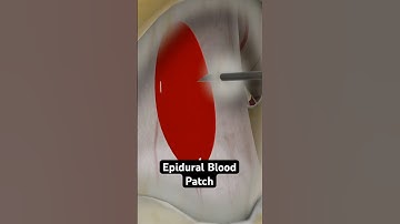 Patching a leaky spine - with blood! (3D Animation)