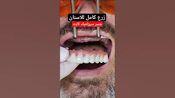 زرع اسنان لكامل الفم وتركيب جسر سيراميك ثابت 