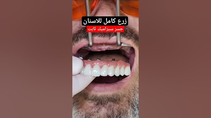 زرع اسنان لكامل الفم وتركيب جسر سيراميك ثابت