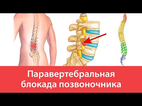 Паравертебральная блокада позвоночника