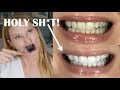 AMAZING TEETH WHITENING HACK! | skip2mylou