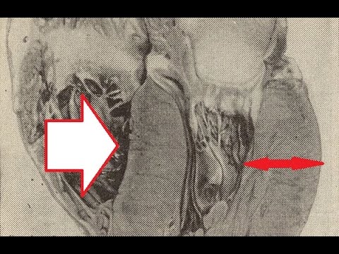ГИПЕРТРОФИЯ. ПАТОЛОГИЧЕСКАЯ АНАТОМИЯ. ГИСТОЛОГИЯ