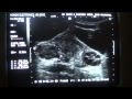 ULTRASOUND: POLYCYSTIC OVARIES