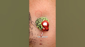 Shaving Over A Mole 😬