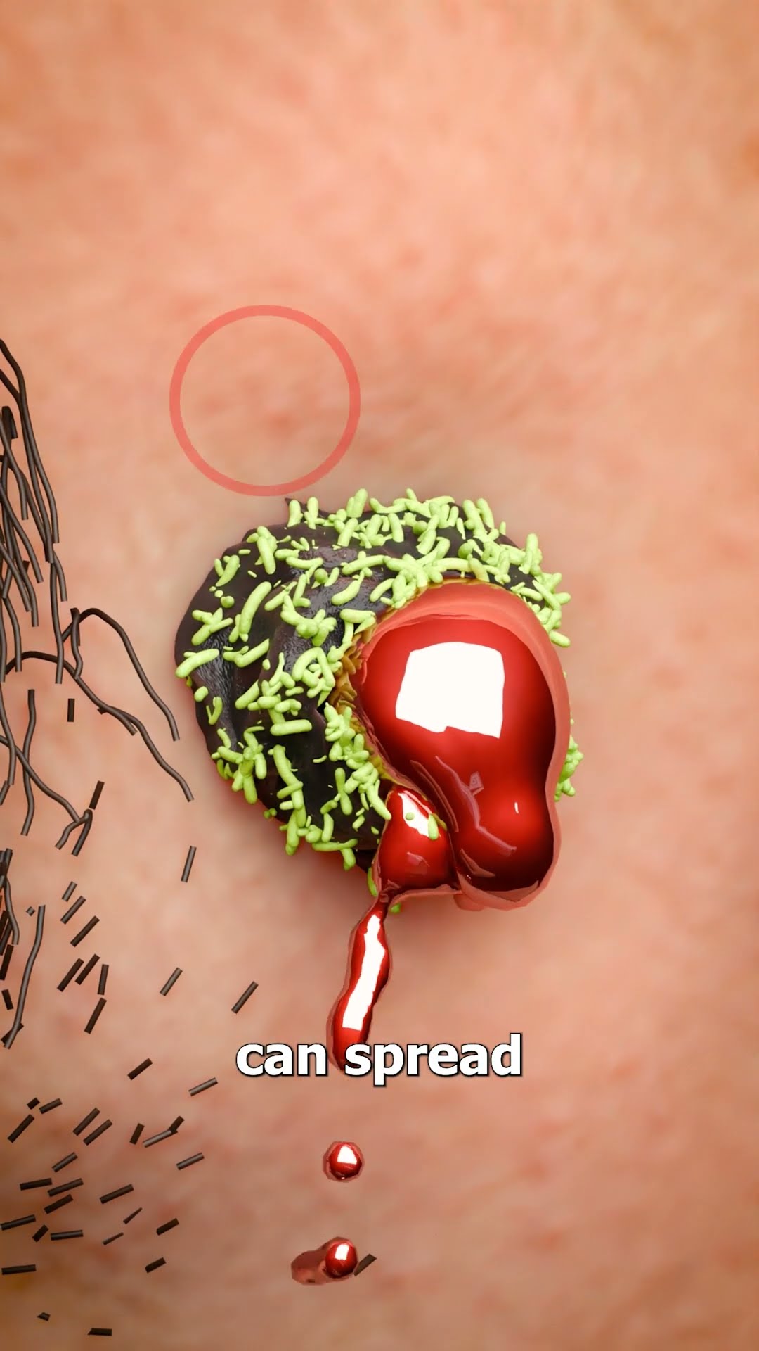 Shaving Over A Mole ?