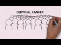 Prevent cervical cancer