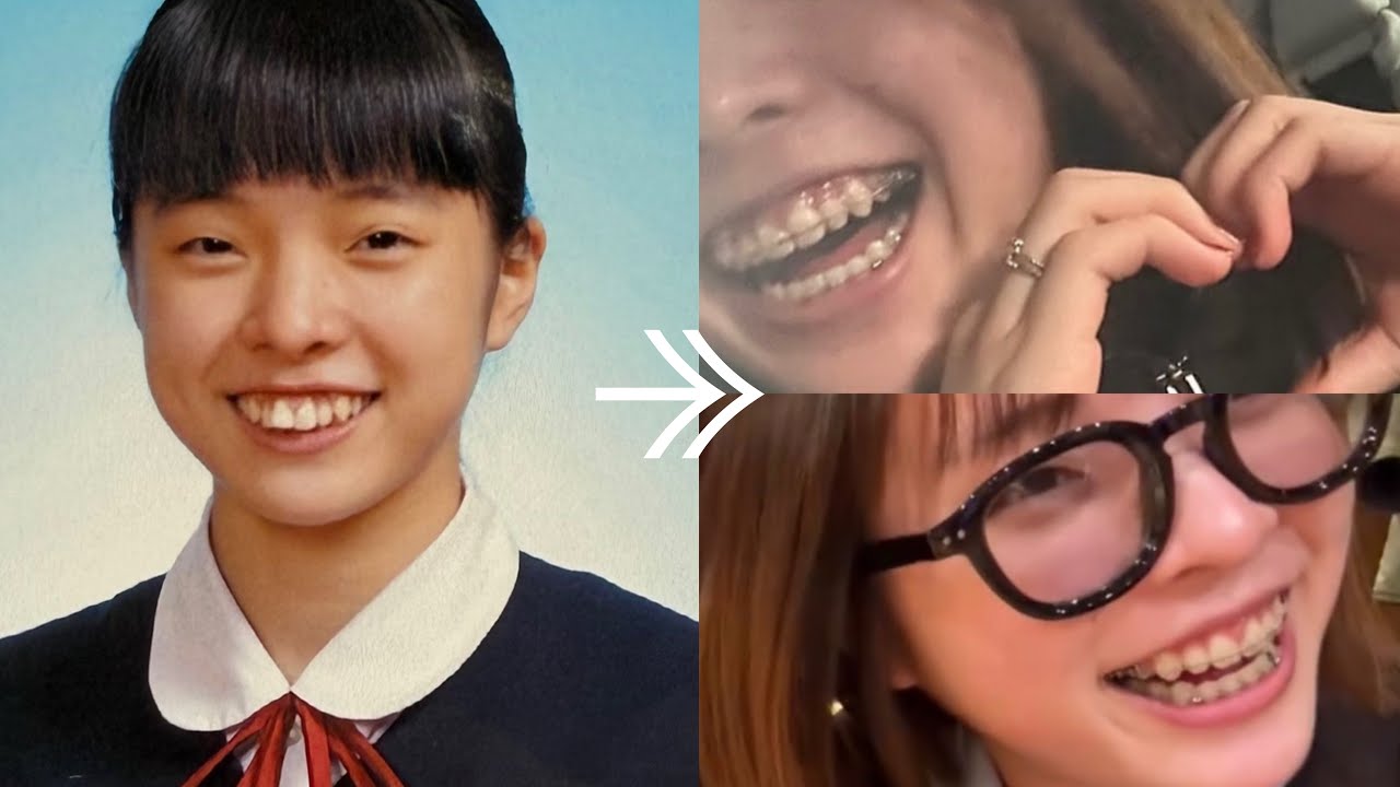 矯正終了間近ということで矯正大成功女が感想を述べているようです