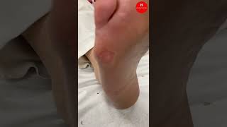 Small Forefoot Callus