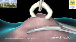 Vasectomy – CIMS Hospital