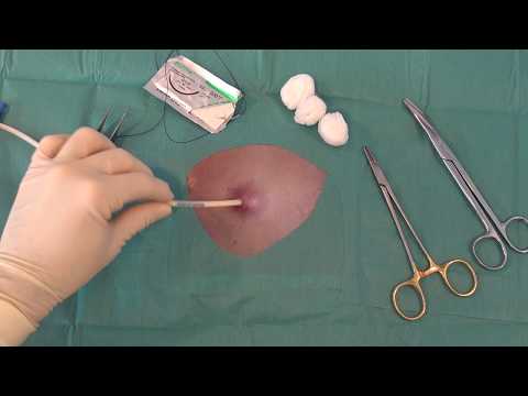 Drensutur / Drain tube suture