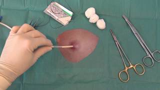 Drain tube suture Net Worth