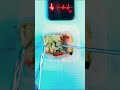 Emergency #FruitSurgery! Mrs Kiwi gets Kidney Transplant 😱 #DiscountDentist #FoodSurgery #MrKiwi