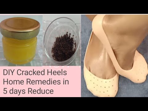 Cracked Heel Remedy | The Beauty Section