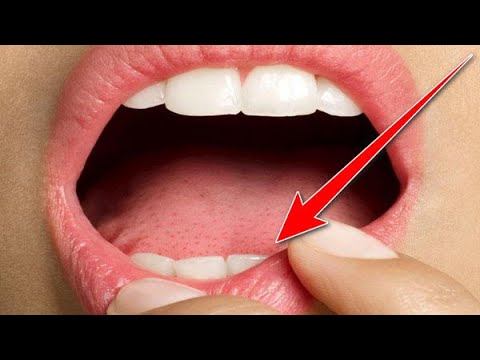 Βίντεο: Γιατί απολέπιση δέρματος στο εσωτερικό του στόματος;