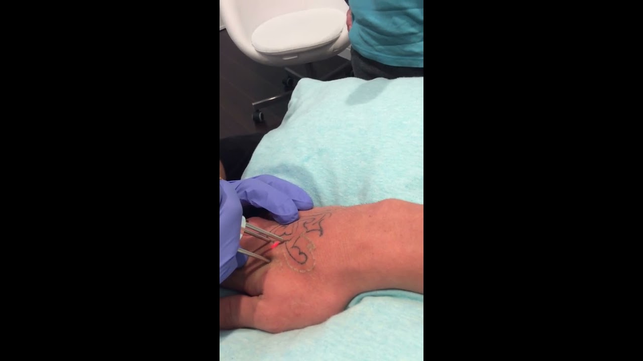 Fresh Start Laser Clinic Area Code Tattoo Removal Austin