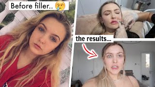 I Got ALL of my Filler Dissolved... *before vs after*