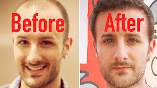 Top hair restoration surgeon and doctor daniel mcgrath discusses the
preventative hairloss treatments such as finasteride, low level laser
light therapy, and...