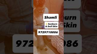 Sunburn &amp; Dull Skin Treatment | Chemical Peel Session #shorts #peeling #face #glowup #youtubeshorts