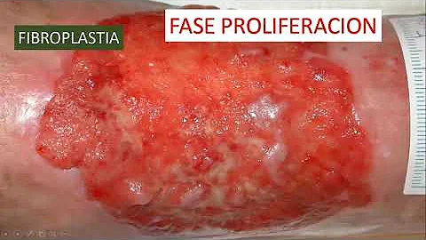 ¿Cuáles son las etapas de la cicatrización de una úlcera venosa?