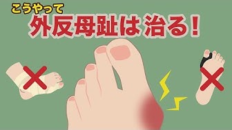 外反母趾 Youtube