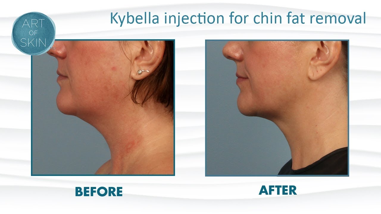 Kybella By Kythera Injection Fat Removal From Chin YouTube kybella-by-kythera-injection-fat-removal-from-chin-youtube