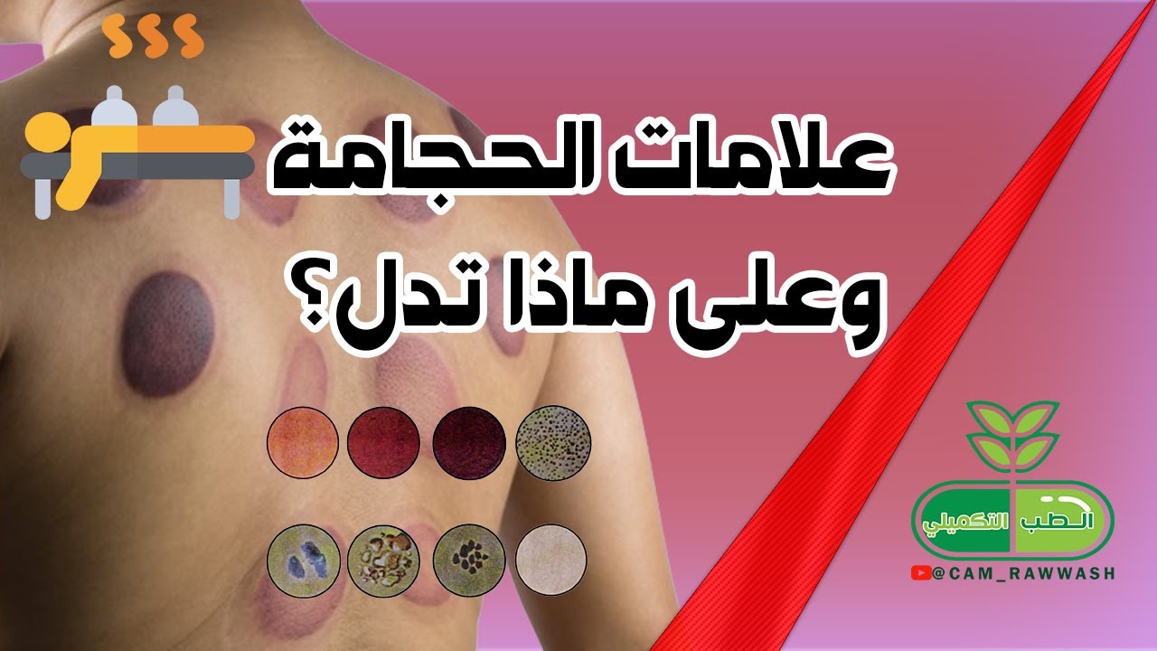 علامات الحجامة وعلى ماذا تدل؟