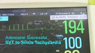 SVT or Supraventricular Tachycardia