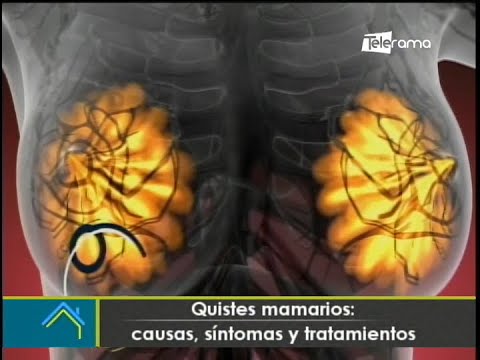 Quistes mamarios: Causas, síntomas y tratamientos
