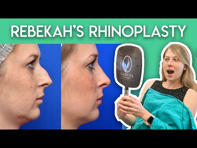 Rebekah's Rhinoplasty Journey