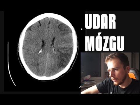 Wideo: Udar Mózgu: Objawy, Leczenie I Długoterminowa Perspektywa