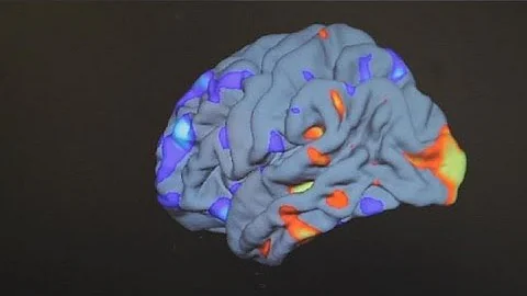 ¿Se puede diagnosticar el autismo con un escáner cerebral?