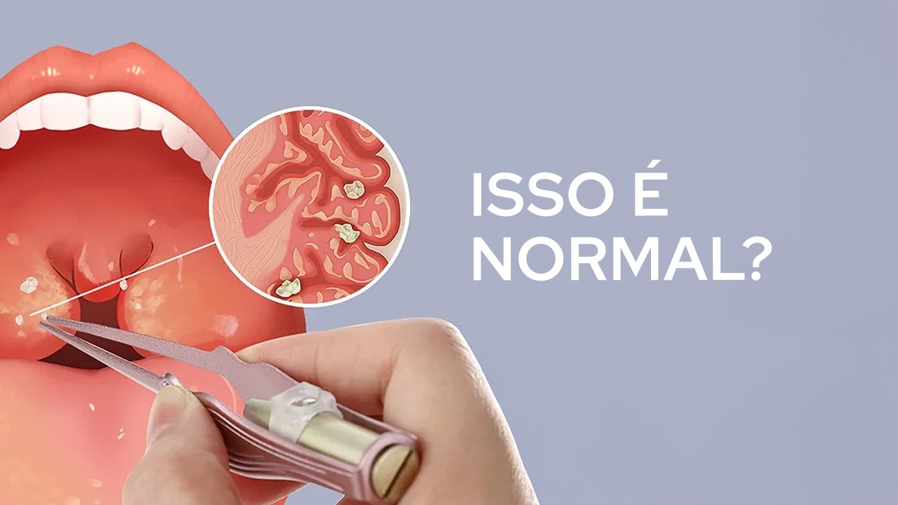 O que são aquelas bolinhas brancas que saem da boca?