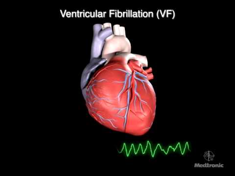What is Ventricular Fibrillation - YouTube