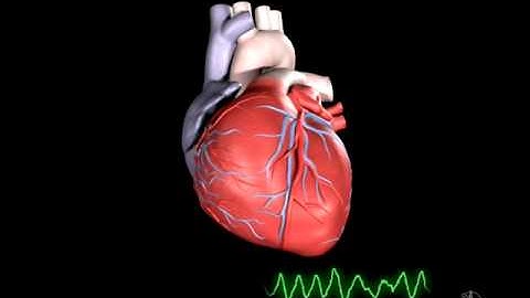 What is Ventricular Fibrillation