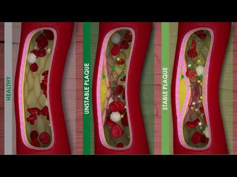 Video: Stenosing Atherosclerosis Of The Arteries - Symptoms And Treatment