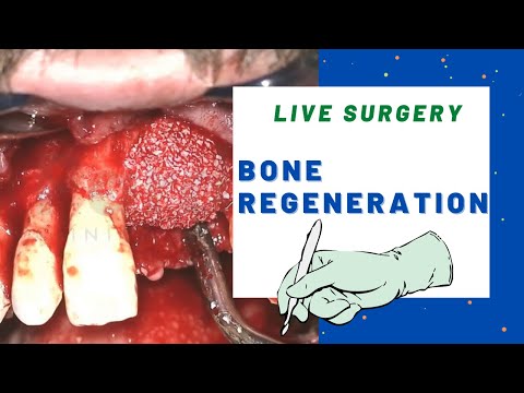 BONE REGENERATION surgery - Bone grafting technique live.