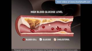 Diabetes: Statin medication