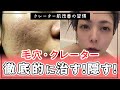 【クレーター肌】自力で徹底的に治す!隠す!毎日の習慣【毛穴】