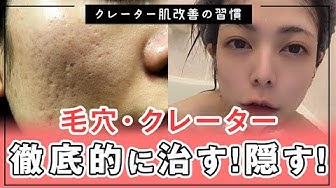 クレーター肌 Youtube