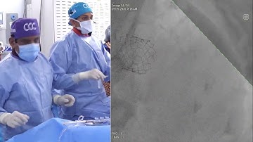 Radial PCI of Long Complex Calcified LAD post TAVR
