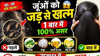 सर की जूँ 1 बार के इस्तेमाल से ख़त्म / Lice Removal at Home जुओं का ख़ात्मा Get rif of Lice